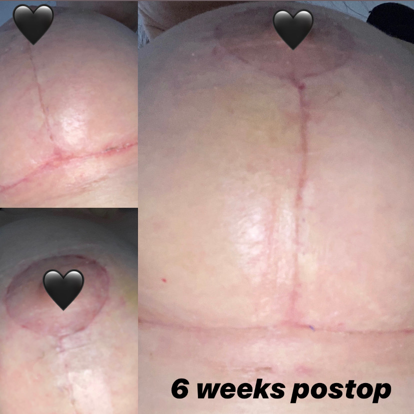 Install heritage Elastic Scarring After Breast Surgery | Inigo Cosmetic