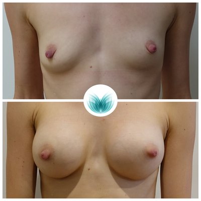 Patient before &amp; after breast implants surgery 02, 265cc, round, low profile, dual plane