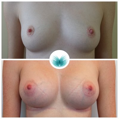 Breast augmentation 285cc, before &amp; after 01, dual plane, Inigo Cosmetic