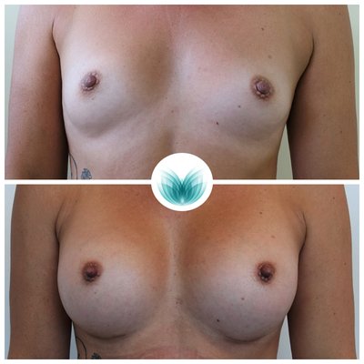 Breast augmentation with implants 315cc, before &amp; after 07, Dr Chinsee
