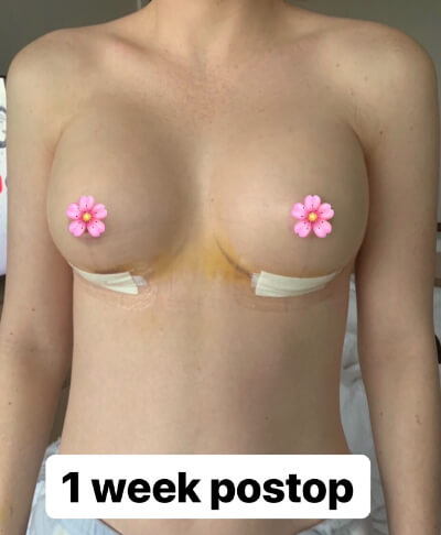 Breast Augmentation Recovery img3 | Inigo Cosmetic