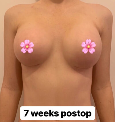 Breast Augmentation Recovery img9 | Inigo Cosmetic