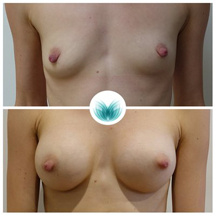 Brisbane breast augmentation before and after 02, Dr Chinsee, Inigo Cosmetic