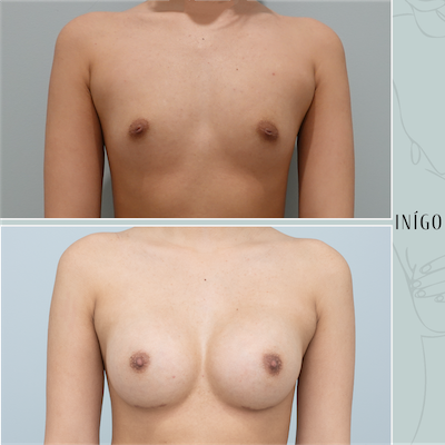 Breast Augmentation with Motiva Ergonomix implants, dual plane, 335cc