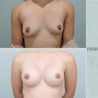 Breast Augmentation with Mentor implants, dual plane, 400cc &amp; 375cc