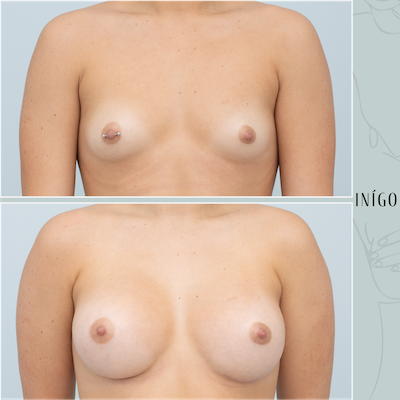 Breast Augmentation with Mentor implants, dual plane, 350cc
