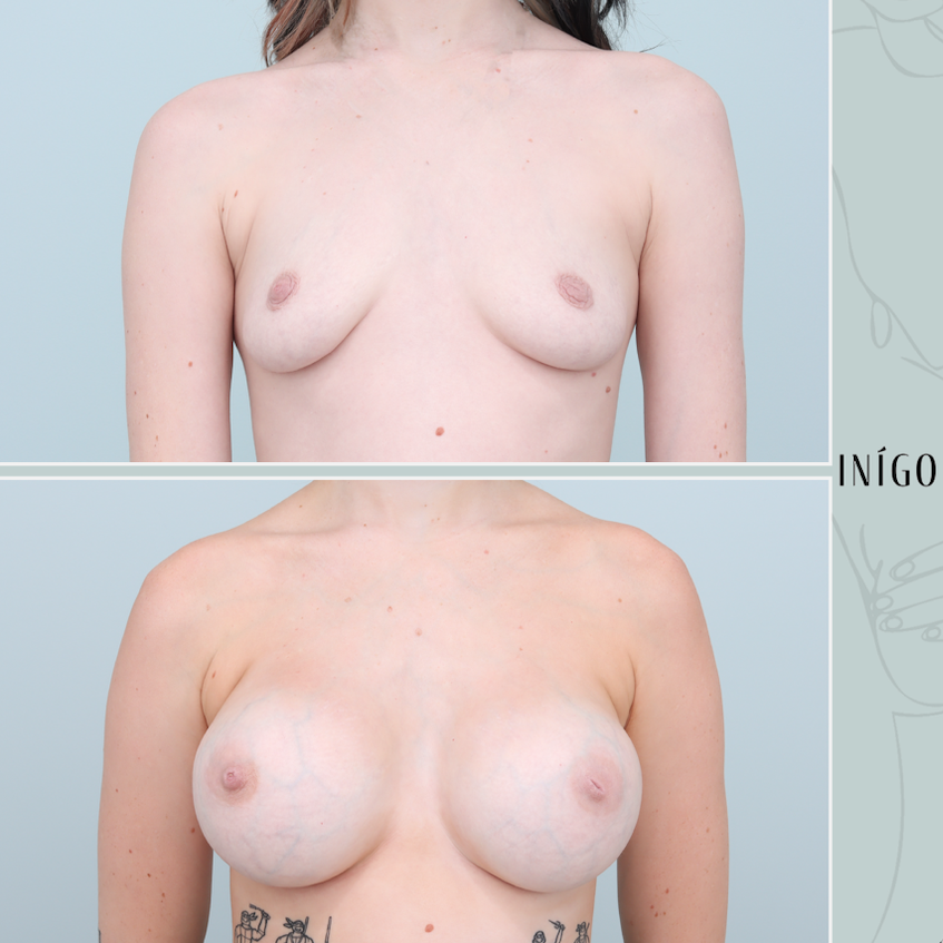 Breast Augmentation with Mentor implants, dual plane, high profile, 480cc