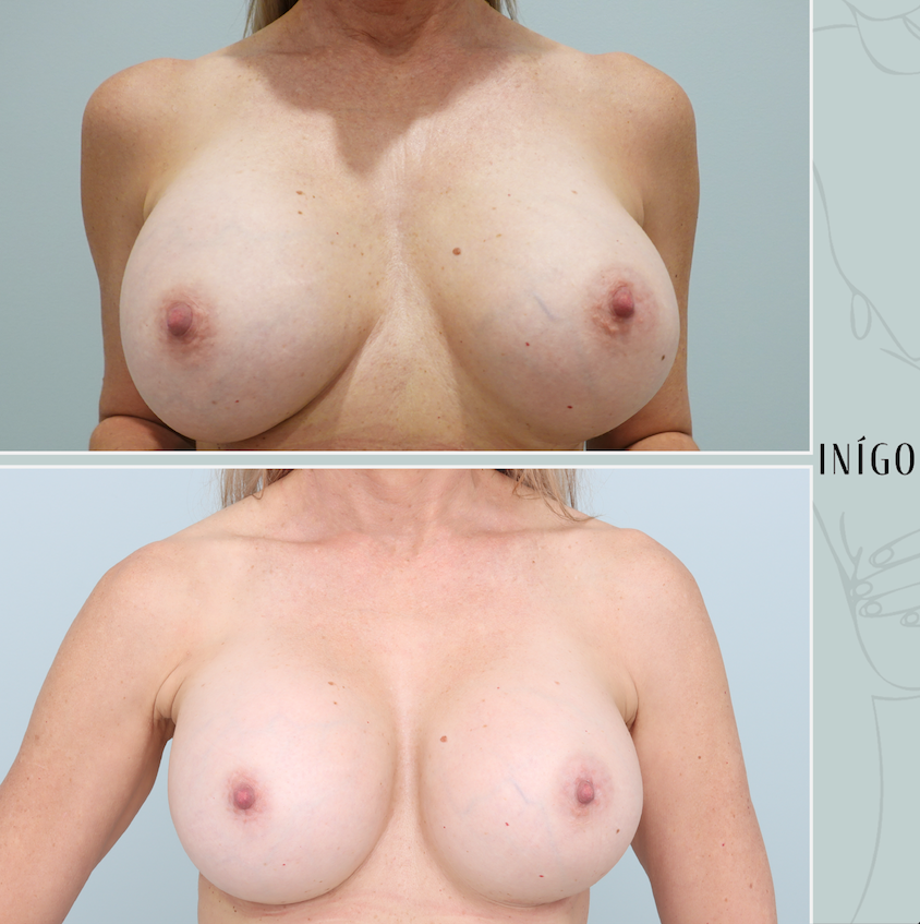 Before and after breast revision surgery, 550cc round, with removal and replacement Inigo Cosmetic