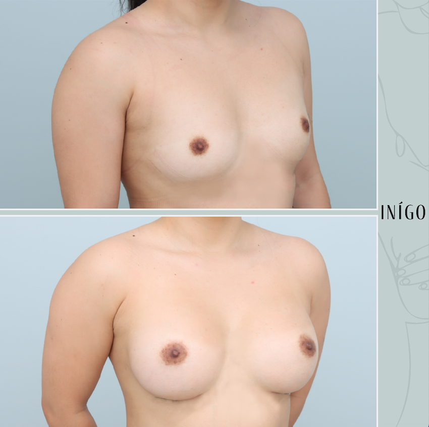 Breast Augmentation with Mentor implants, dual plane, moderate plus profile, 250cc