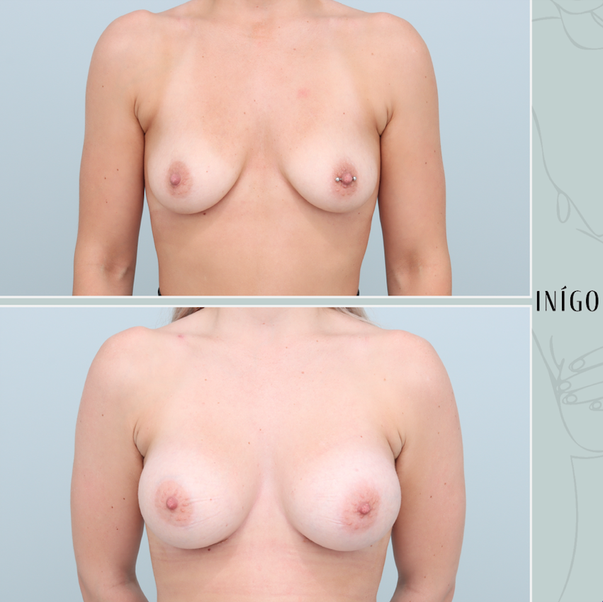 Breast Augmentation with Mentor implants, dual plane, high profile, 275cc