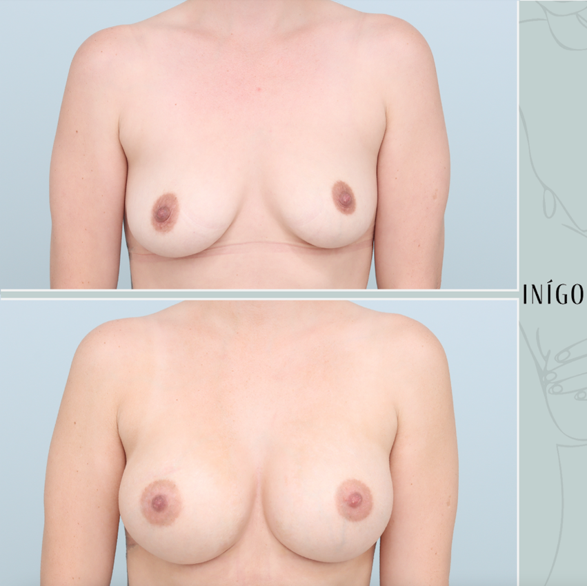 Breast Augmentation with Mentor implants, dual plane, 300cc