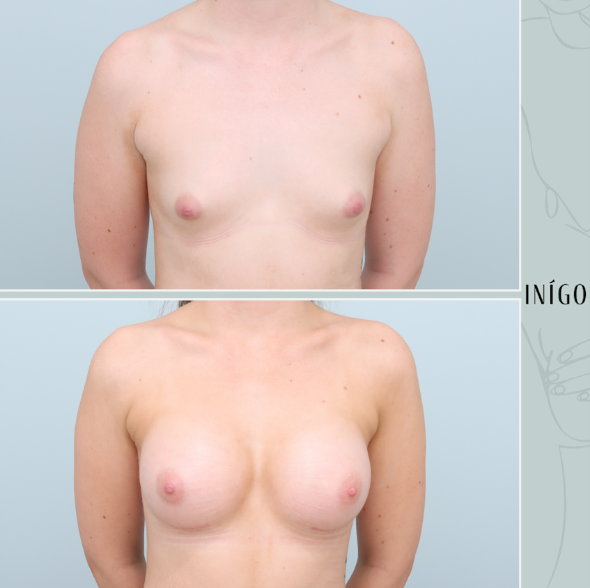 Breast Augmentation with Mentor implants, dual plane, high profile, 345cc