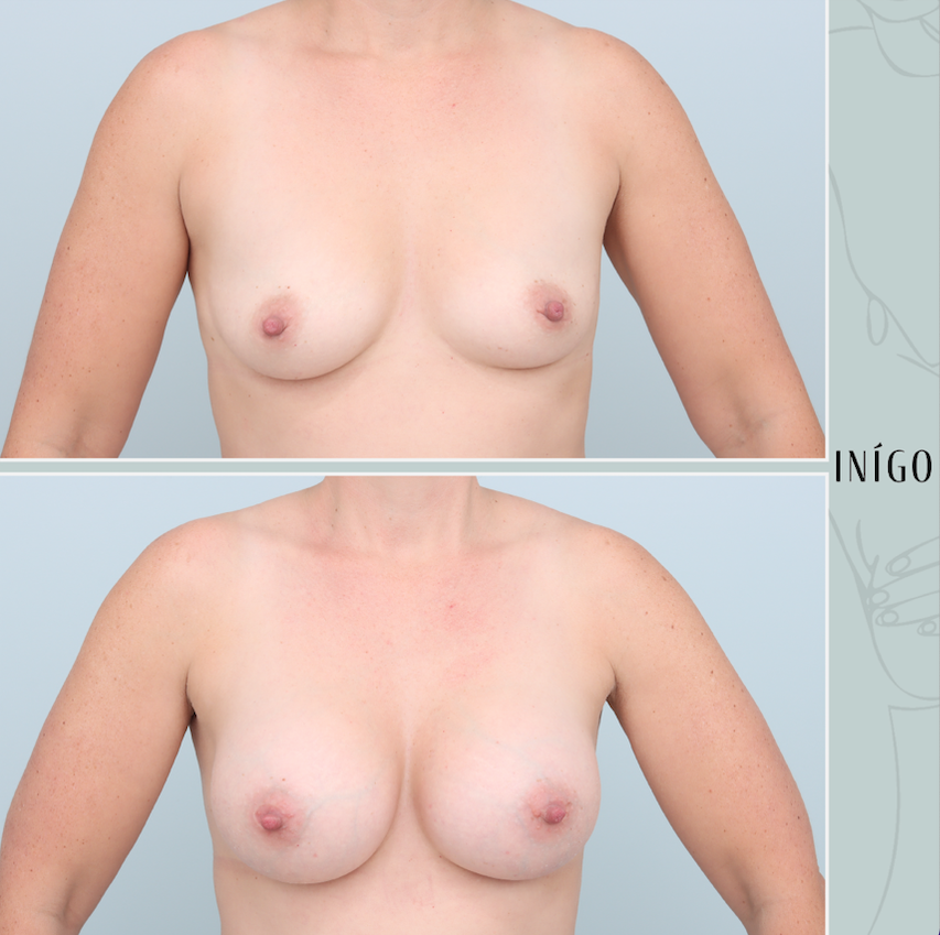 Breast Augmentation with Mentor implants, dual plane, high profile, 350cc &amp; 375cc