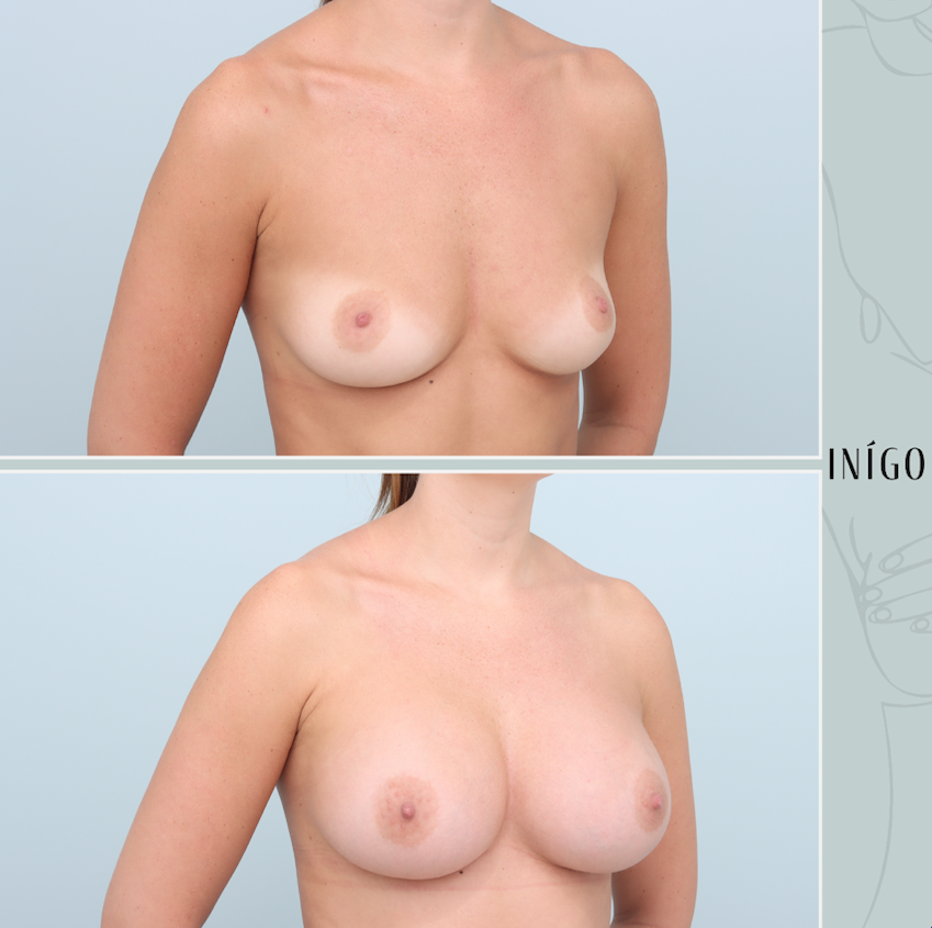 Breast Augmentation with Mentor implants, dual plane, high profile, 350cc