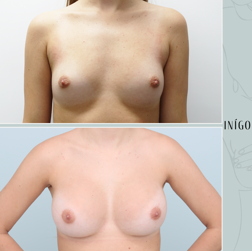 Breast Augmentation with Motiva implants, dual plane, high profile, 355cc