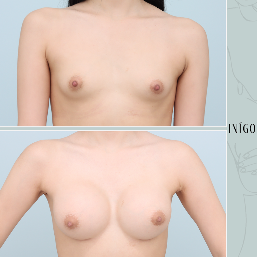 Breast Augmentation with Mentor implants, dual plane, high profile, 355cc