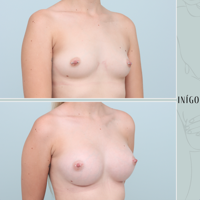 Breast Augmentation with Mentor implants, dual plane, high profile, 375cc