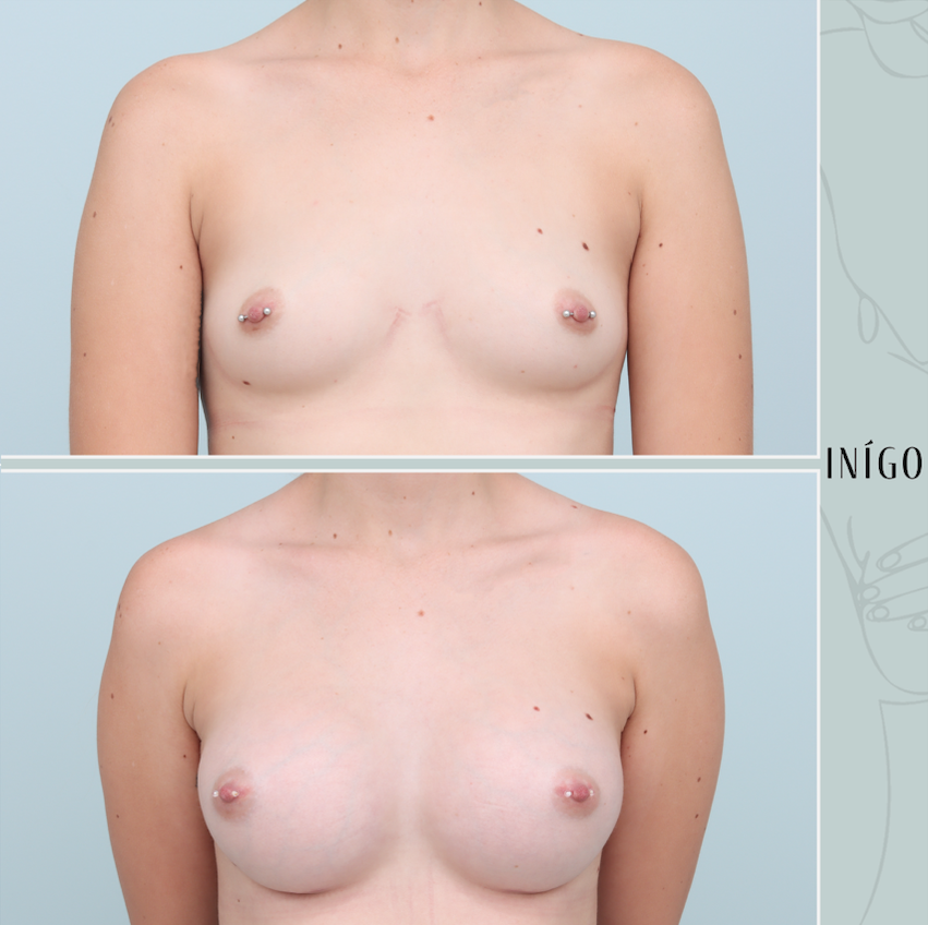 Breast Augmentation with Mentor implants, dual plane, high profile, 375cc