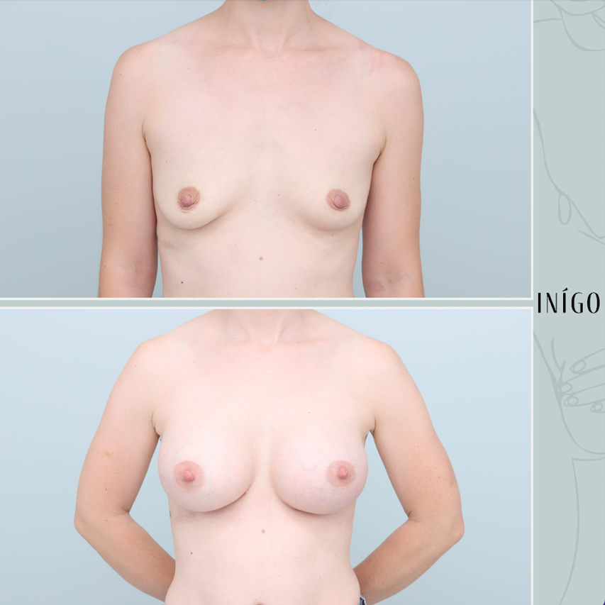 Breast Augmentation with Mentor implants, dual plane, high profile, 390cc