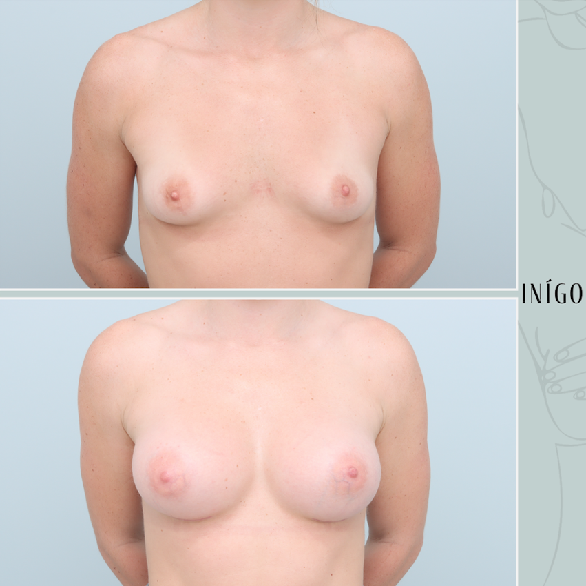 Breast Augmentation with Motiva implants, dual plane, high profile, 395cc
