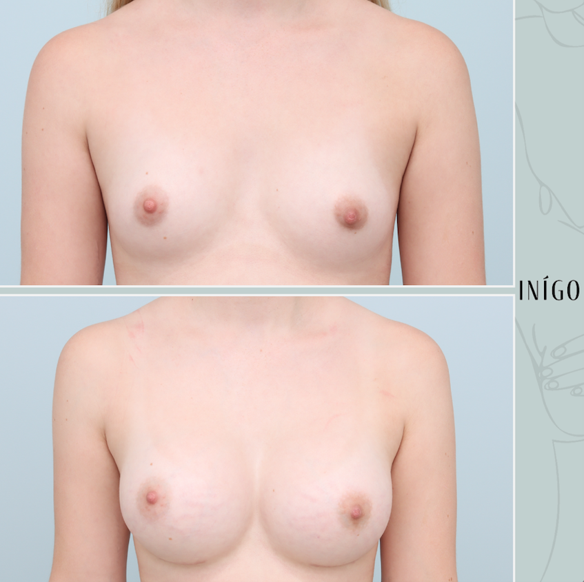 Breast Augmentation with Mentor implants, dual plane, high profile, 400cc
