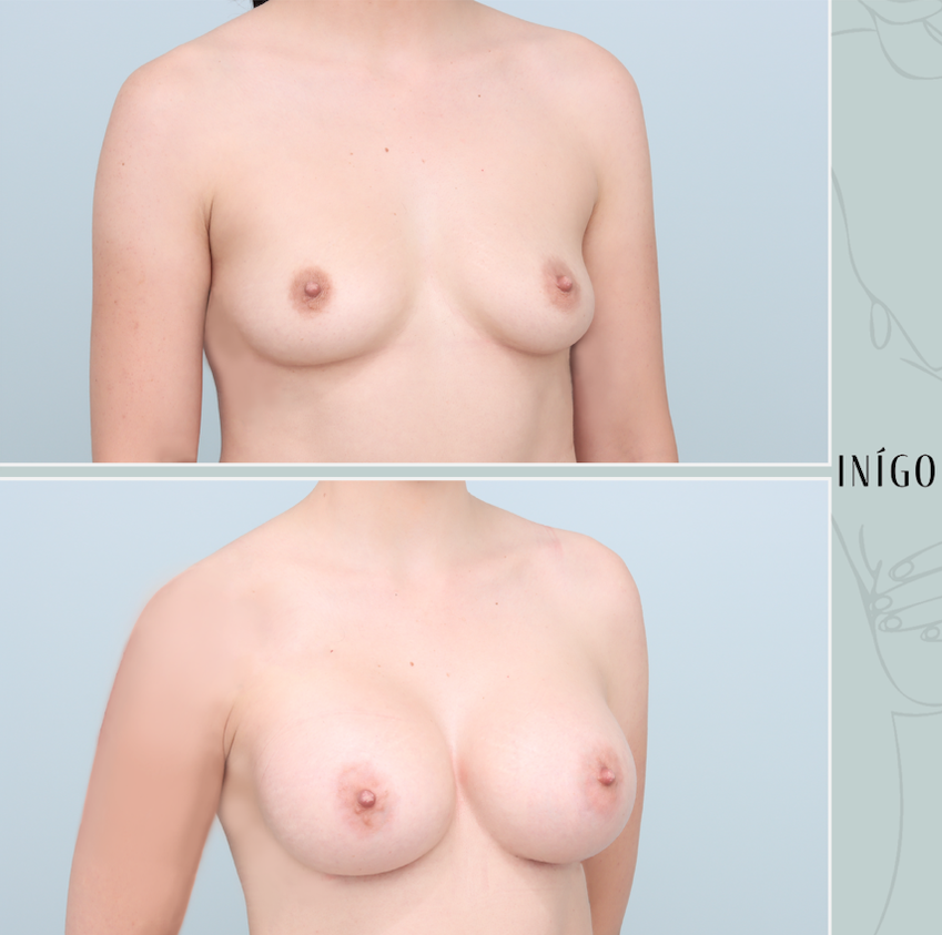 Breast Augmentation with Mentor implants, dual plane, high profile, 400cc