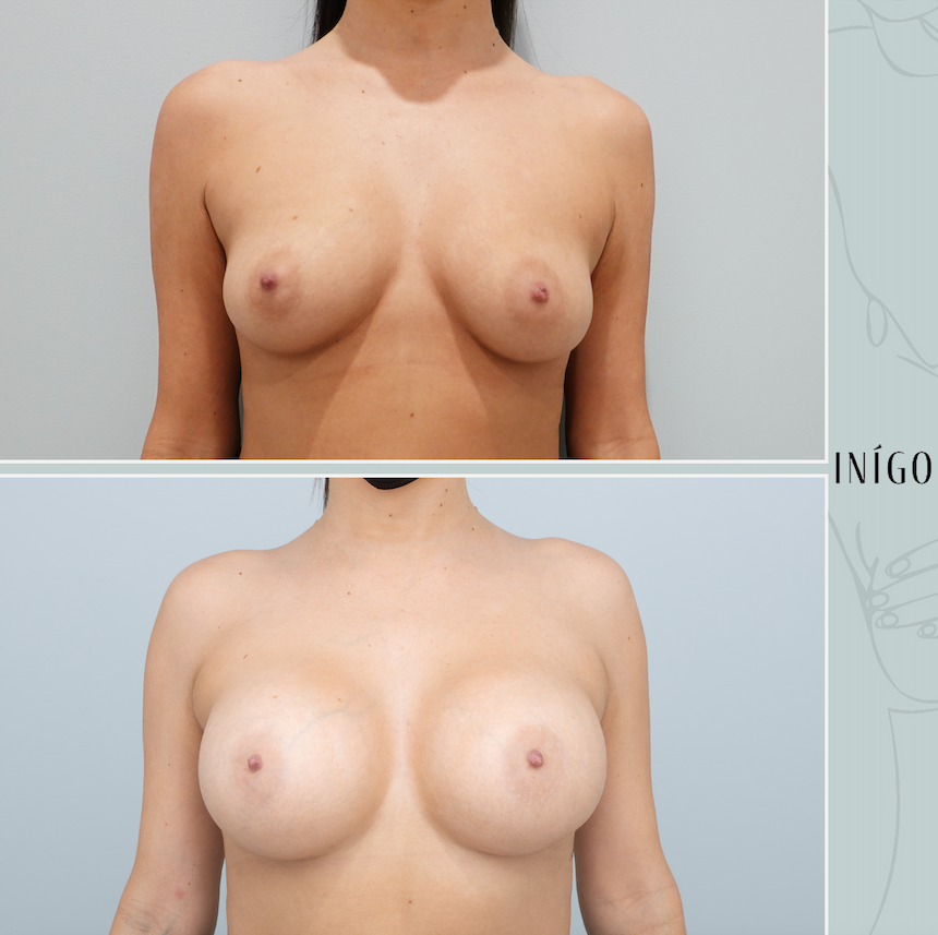 Breast Augmentation with Mentor implants, dual plane, 400cc