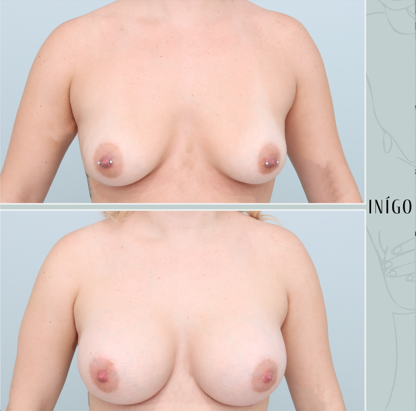 Breast Augmentation with Mentor implants, dual plane, 425cc 450cc