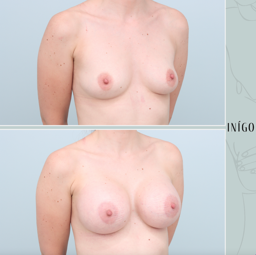 Breast Augmentation with Motiva implants, dual plane, high profile, 425cc