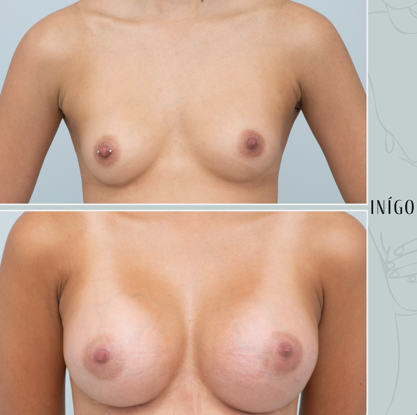 Breast Augmentation with Mentor implants, dual plane, ultra high profile, 430cc