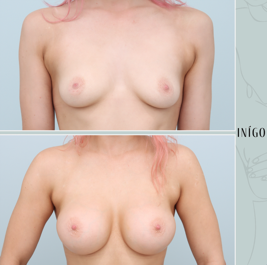 Breast Augmentation with Mentor implants, dual plane, high profile, 430cc