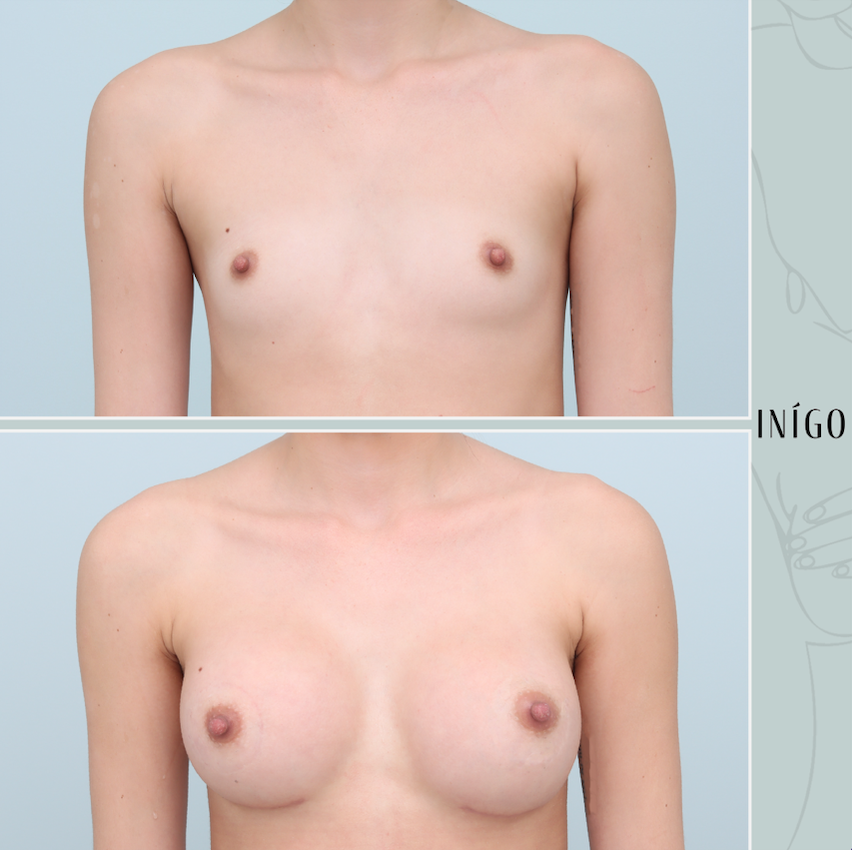 Breast Augmentation with Mentor implants, dual plane, high profile, 430cc