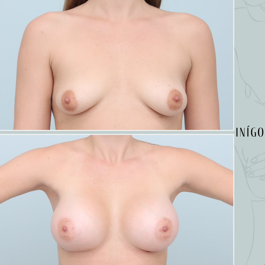 Breast Augmentation with Motiva implants, dual plane, high profile, 430cc