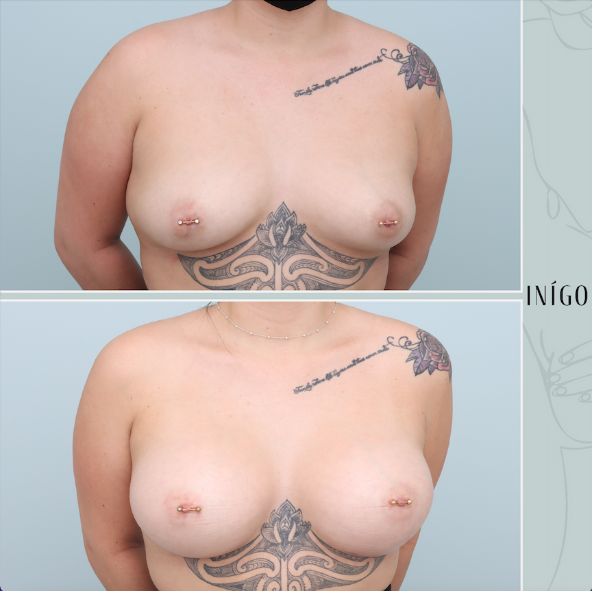 Breast Augmentation with Mentor implants, dual plane, 590cc