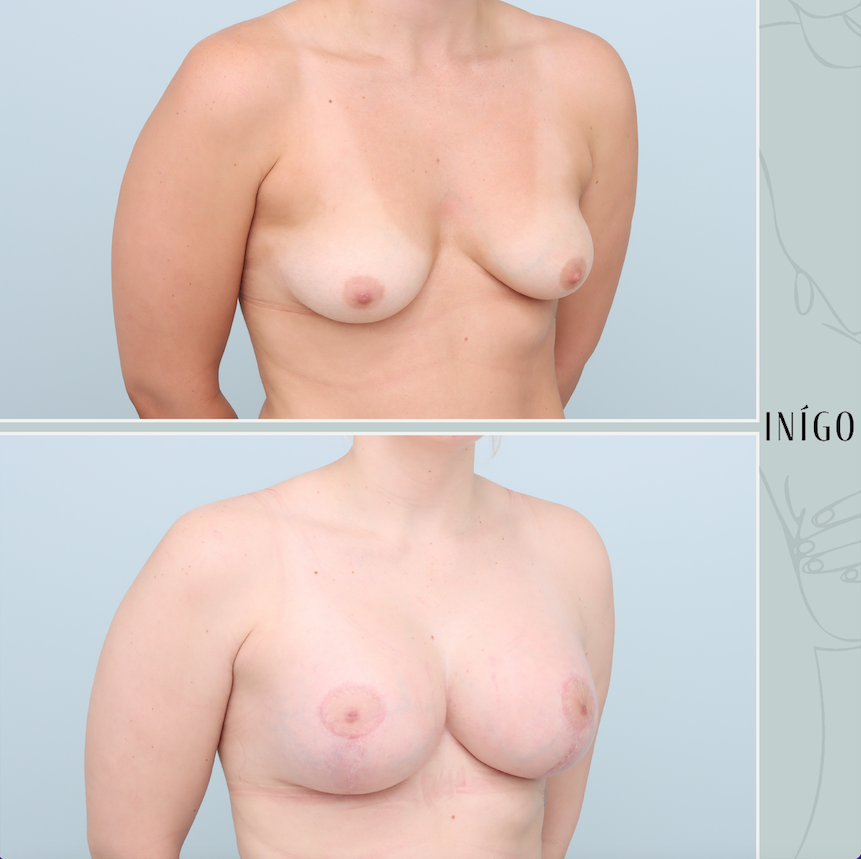 Breast Augmentation with Mastopexy, Mentor implants, dual plane, 350cc