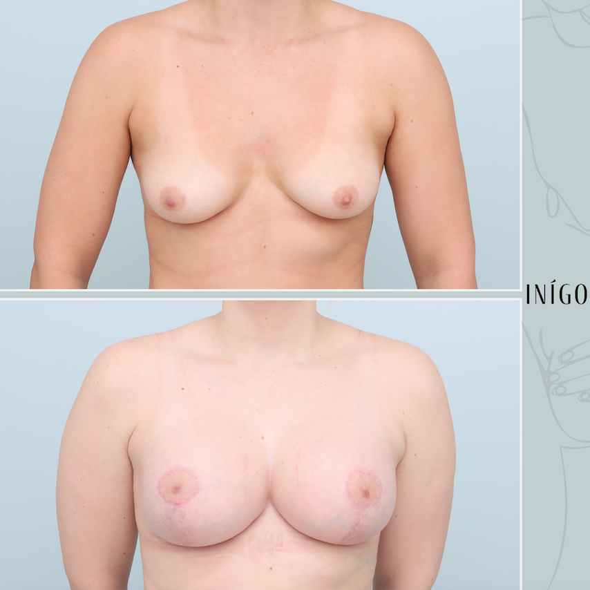 Breast Augmentation with Mastopexy, Mentor implants, dual plane, 350cc