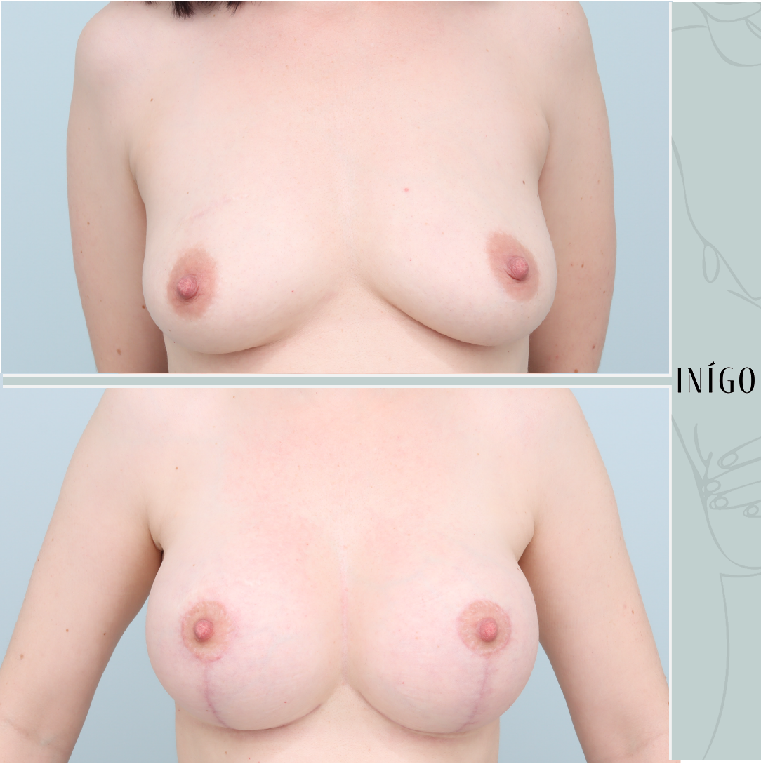 Breast Augmentation with Mastopexy and Symmastia repair, Mentor implants, dual plane, 350cc