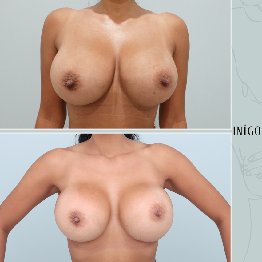 Removal and replacement with Motiva implants, dual plane, high profile, 725cc &amp; 825cc