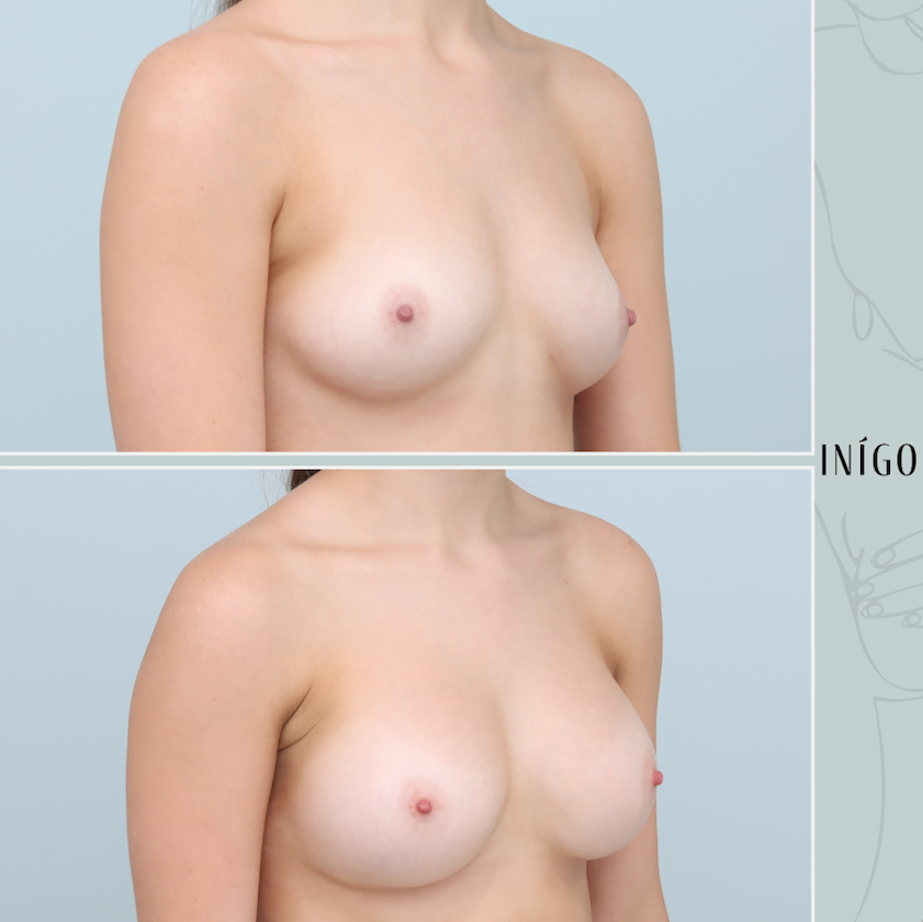Breast Augmentation with Mentor implants, dual plane, high profile, 350cc
