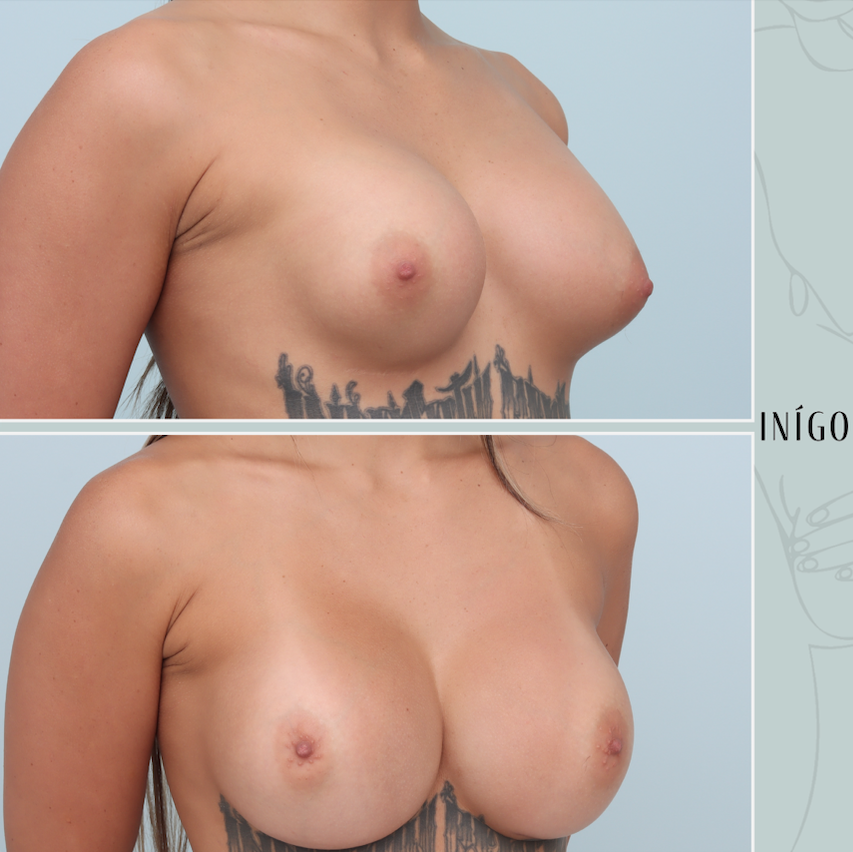 Before and after breast revision surgery, 625cc round, with removal and replacement Inigo Cosmetic