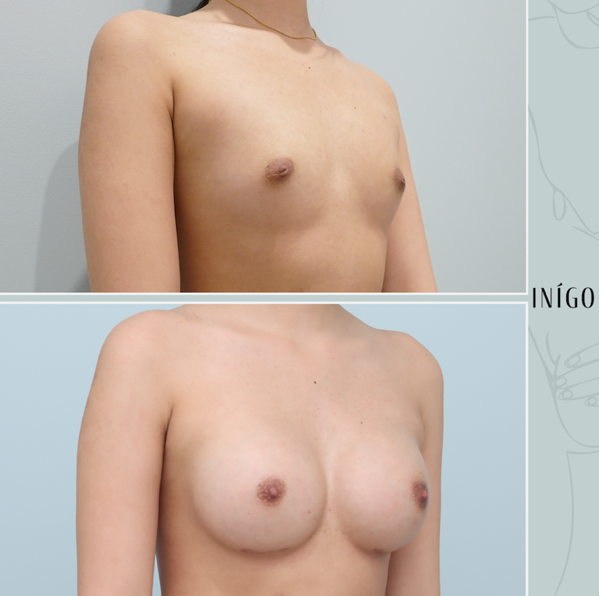 Breast Augmentation with Motiva Ergonomix implants, dual plane, 335cc