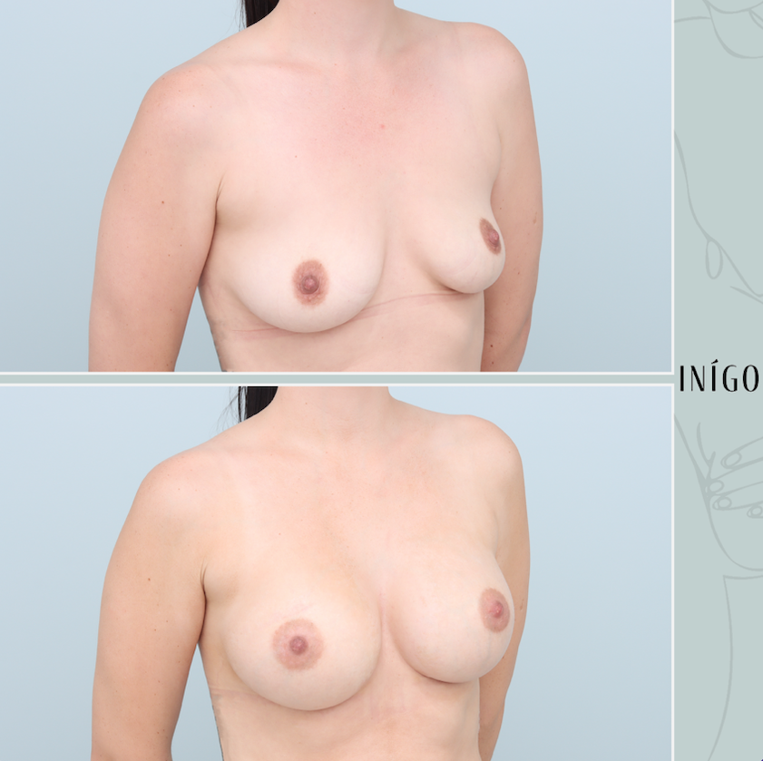 Breast Augmentation with Mentor implants, dual plane, 300cc