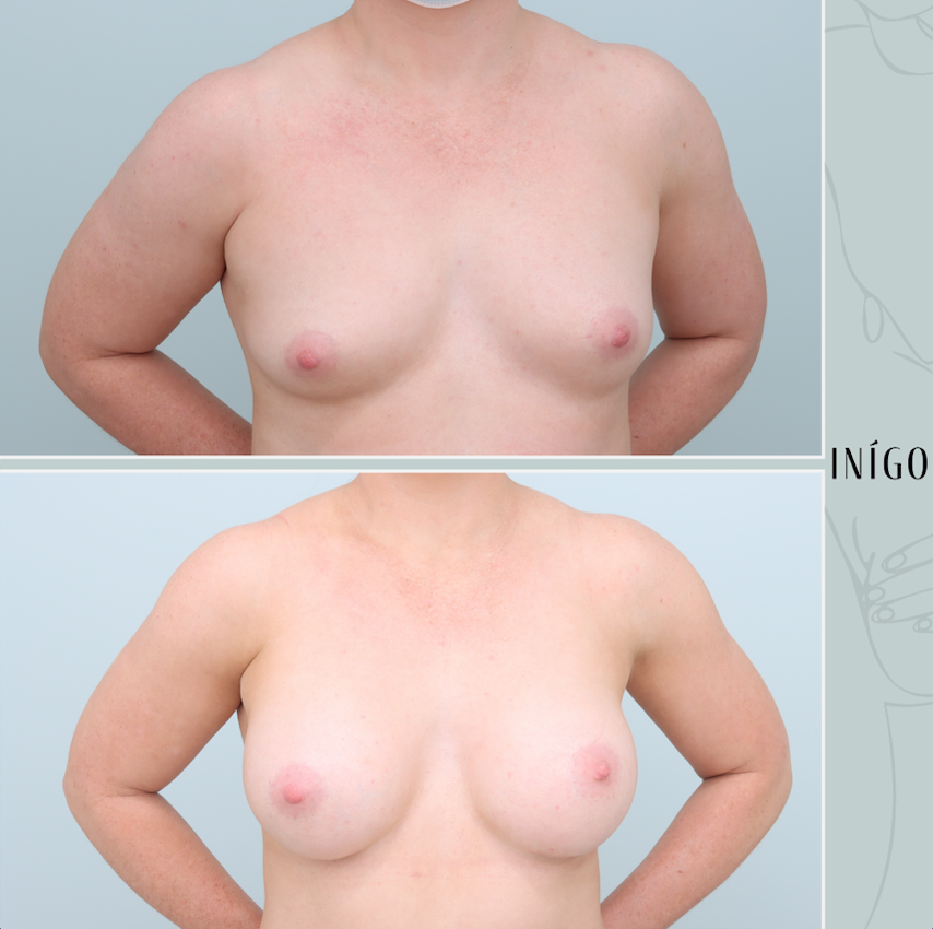 Breast Augmentation with Mentor implants, dual plane, high profile, 350cc &amp; 375cc