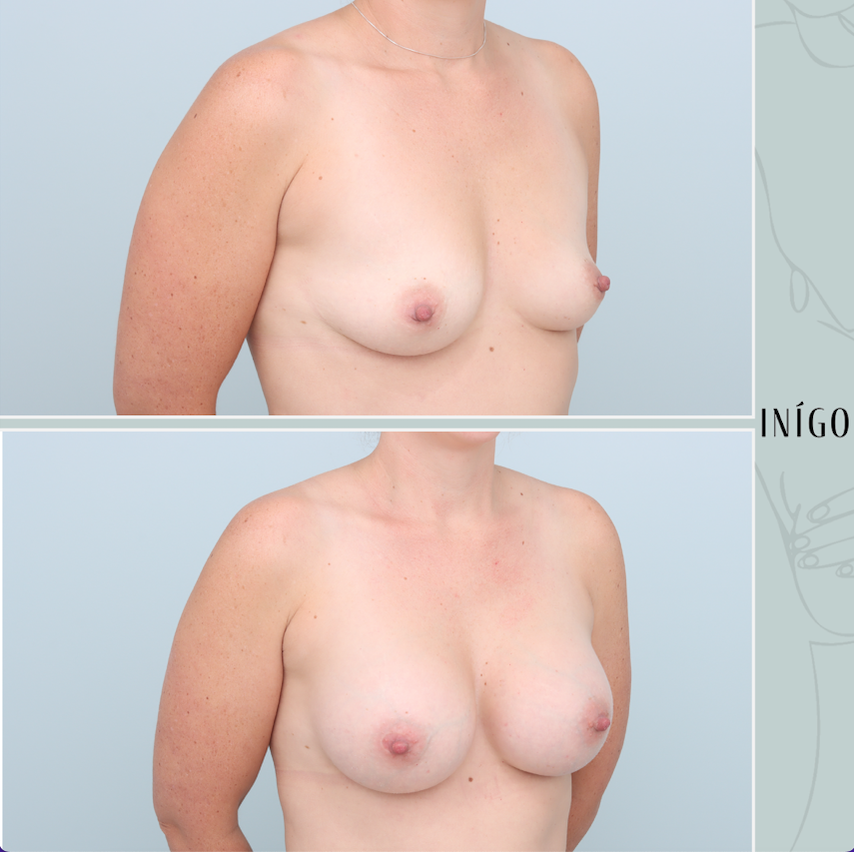 Breast Augmentation with Mentor implants, dual plane, high profile, 375cc &amp; 350cc