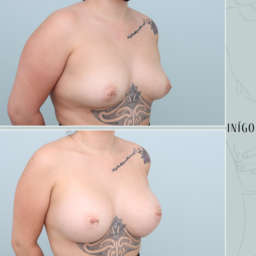 Breast Augmentation with Mentor implants, dual plane, 590cc