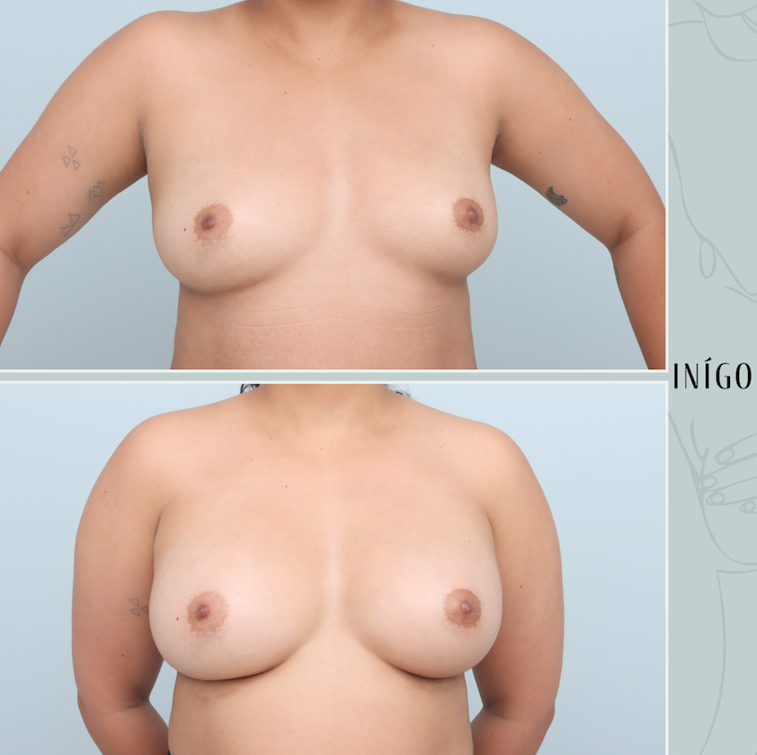 Breast Augmentation and Fat Transfer with Mentor implants, dual plane, 300-350cccc