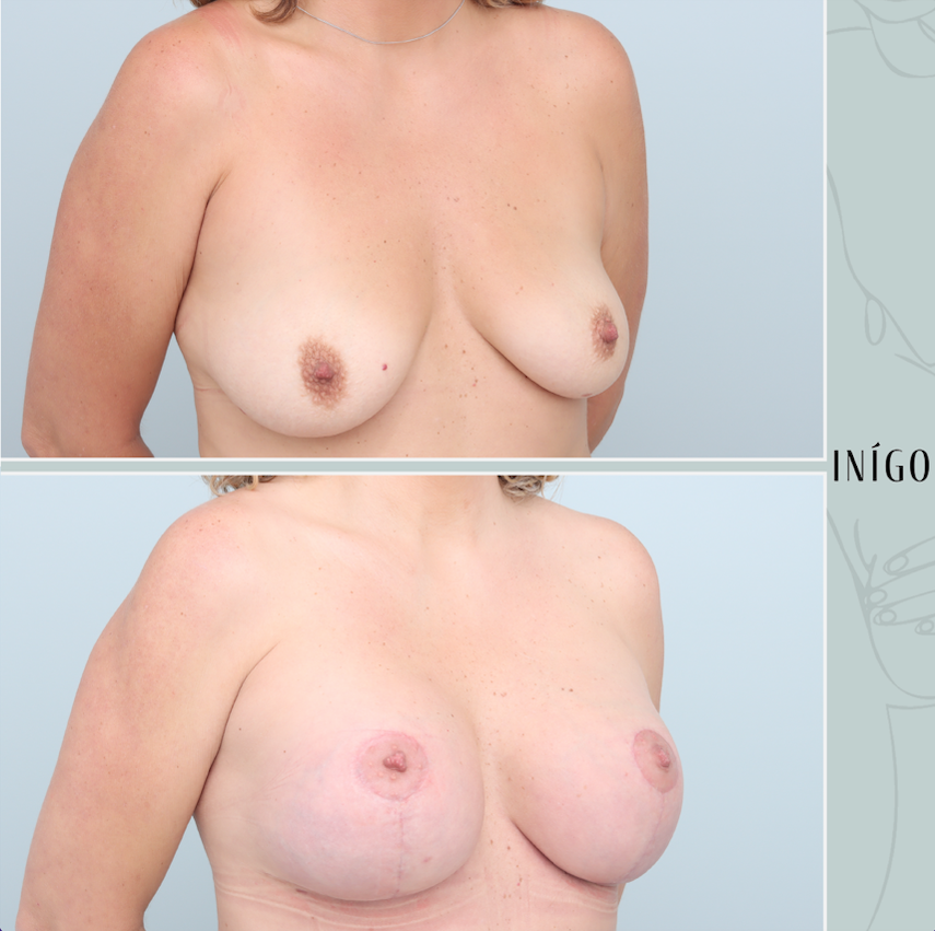 Breast augmentation and Mastopexy with Mentor implants, dual plane, high profile, 450cc