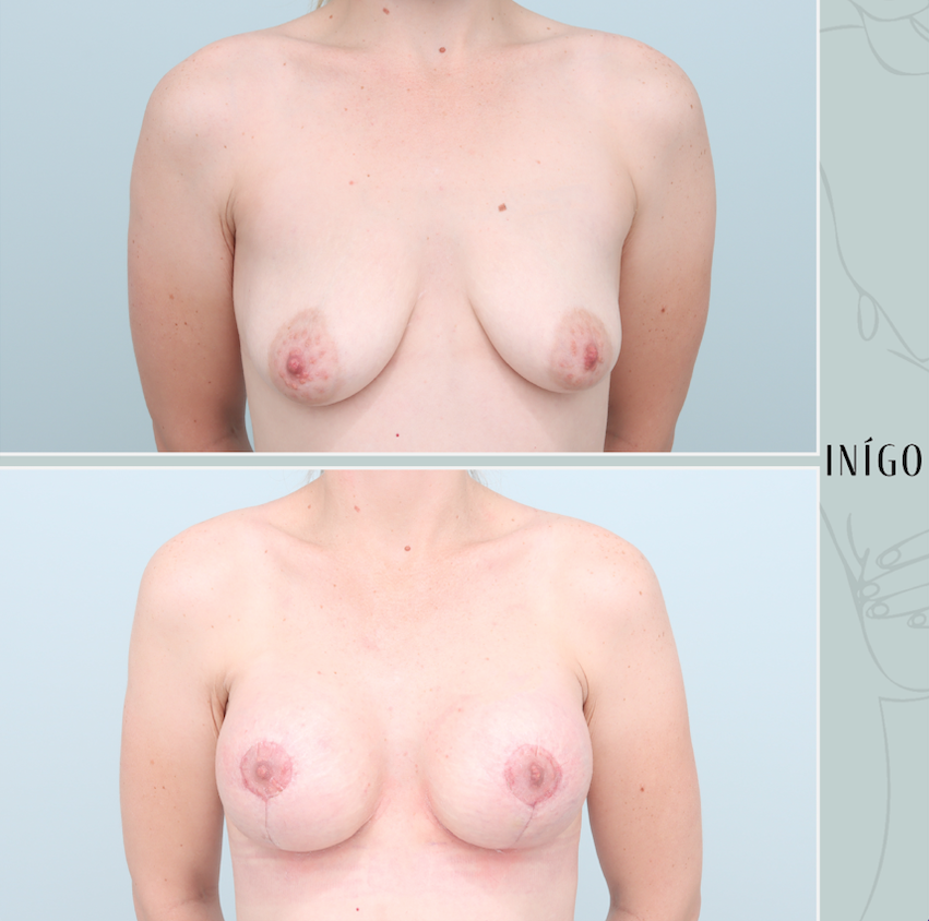 Breast Augmentation and Mastopexy with Motiva implants, dual plane, high profile, 315cc