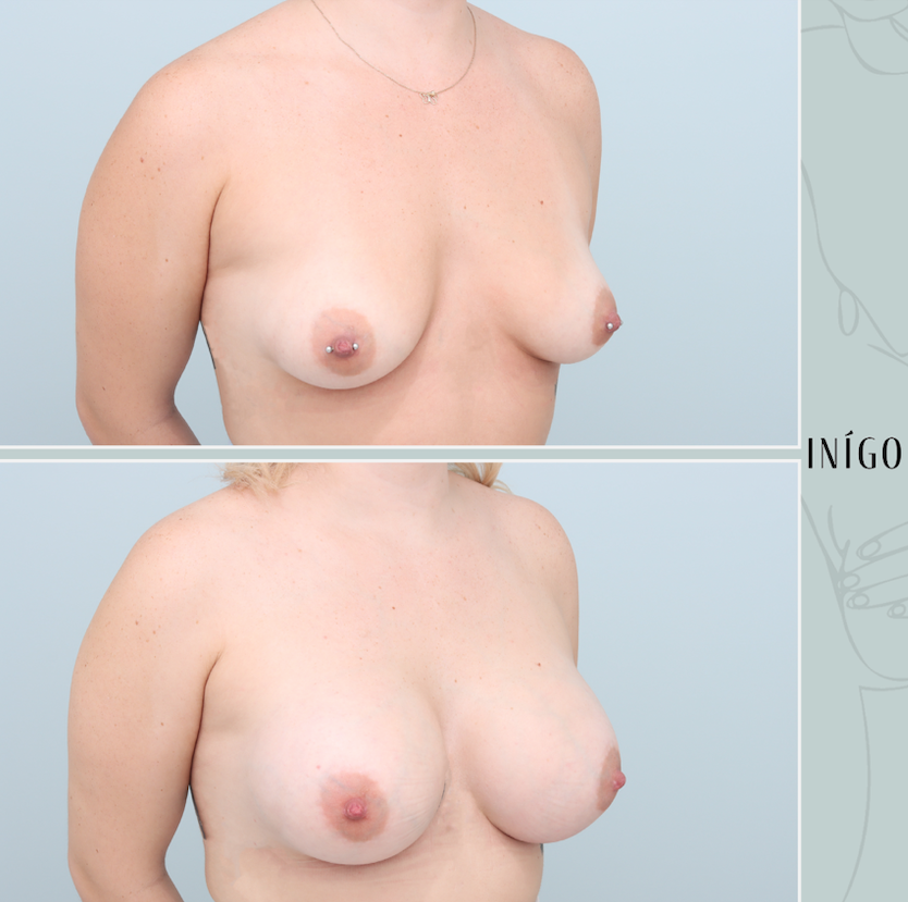 Breast Augmentation with Mentor implants, dual plane, 425cc &amp; 450cc