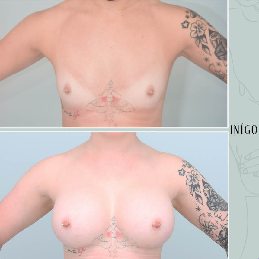 Breast Augmentation with Mentor implants, dual plane, tear drop, 430cc